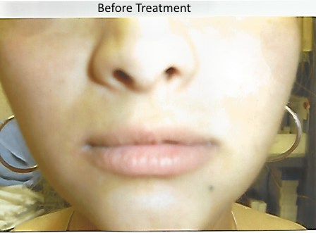Example 1 Before Treatment