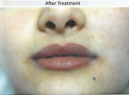 Example 1 After Treatment