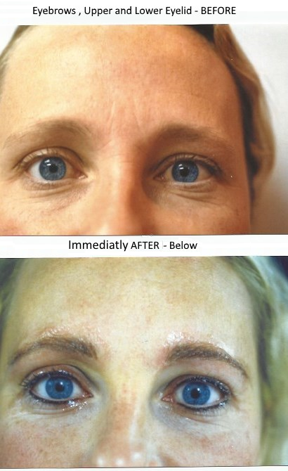 Example 2 Before and Immediatly After Treatment